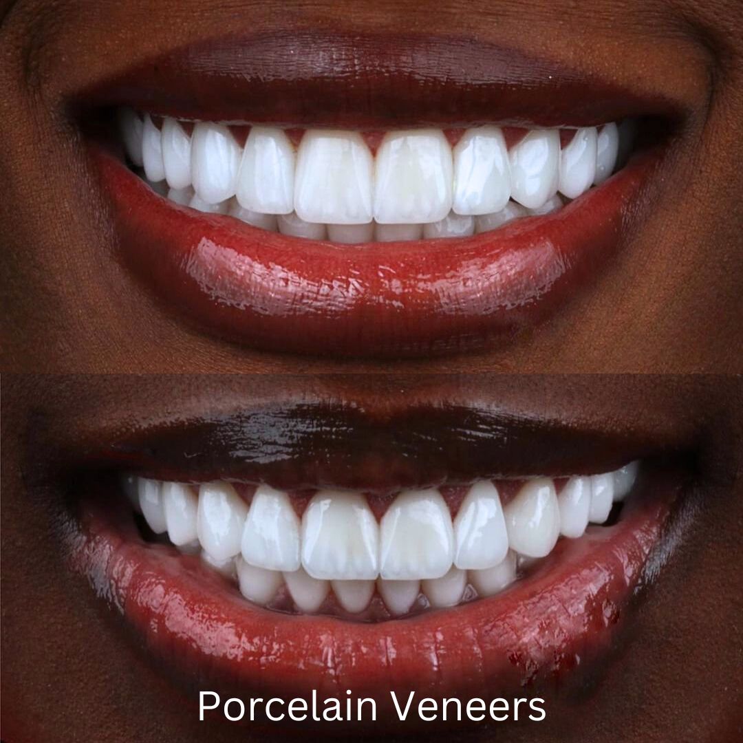 Moderna Dental Porcelain Veneers in Miami