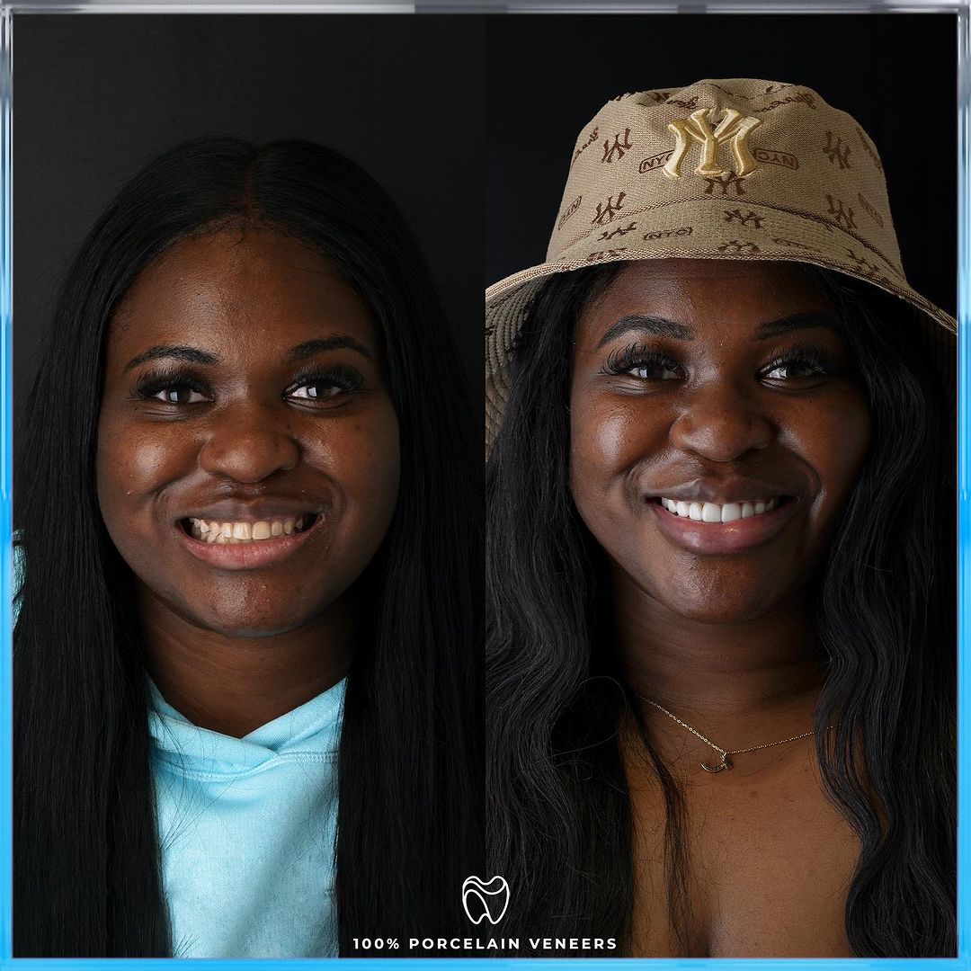 Masterpieces of smiles crafted with passion and precision! 🎨 Let us help you design the perfect, dazzling smile that will turn heads and leave you beaming with confidence